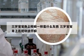 三歲寶寶身上和癬一樣是什么東西 三歲寶寶身上出現(xiàn)塊狀干癬