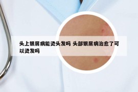 頭上銀屑病能燙頭發(fā)嗎 頭部銀屑病治愈了可以燙發(fā)嗎