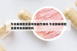 牛皮癬用他克莫司有副作用嗎 牛皮膚癬用他克莫司有依賴性嗎