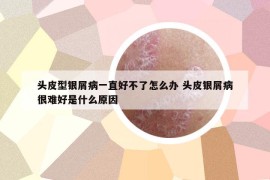 頭皮型銀屑病一直好不了怎么辦 頭皮銀屑病很難好是什么原因