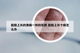 屁股上長的像癬一樣的東西 屁股上長個癬怎么辦