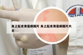 身上起皮像是癬圖片 身上起皮像是癬圖片大全