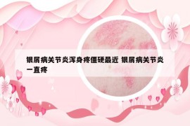 銀屑病關(guān)節(jié)炎渾身疼僵硬最近 銀屑病關(guān)節(jié)炎一直疼