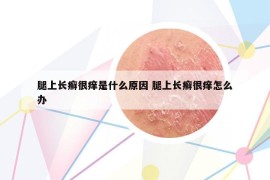 腿上長癬很癢是什么原因 腿上長癬很癢怎么辦