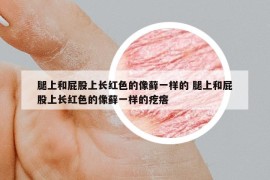 腿上和屁股上長紅色的像蘚一樣的 腿上和屁股上長紅色的像蘚一樣的疙瘩