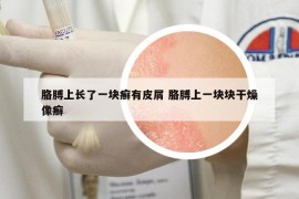 胳膊上長(zhǎng)了一塊癬有皮屑 胳膊上一塊塊干燥像癬
