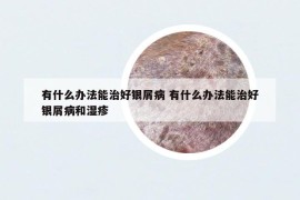 有什么辦法能治好銀屑病 有什么辦法能治好銀屑病和濕疹