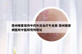德州哪里祖?zhèn)髦兴幫庀粗委熍Ｆぐ_ 德州銀屑病醫(yī)院中醫(yī)研究所地址