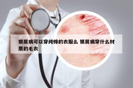 銀屑病可以穿純棉的衣服么 銀屑病穿什么材質(zhì)的毛衣