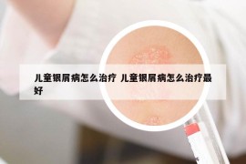 兒童銀屑病怎么治療 兒童銀屑病怎么治療最好