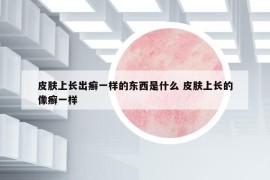 皮膚上長出癬一樣的東西是什么 皮膚上長的像癬一樣