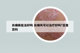 白癩瘋能治好嗎 白癩風(fēng)可以治療好嗎?百度百科