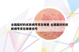 全國最好的皮膚病專家在哪里 全國最好的皮膚病專家在哪里掛號