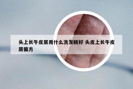 頭上長牛皮屑用什么洗發(fā)精好 頭皮上長牛皮屑偏方