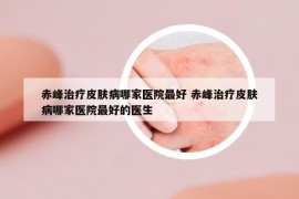 赤峰治療皮膚病哪家醫(yī)院最好 赤峰治療皮膚病哪家醫(yī)院最好的醫(yī)生
