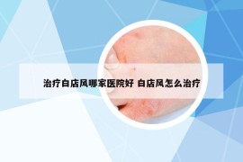 治療白店風(fēng)哪家醫(yī)院好 白店風(fēng)怎么治療