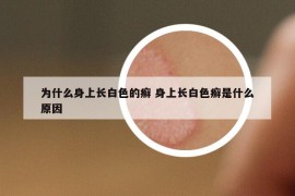 為什么身上長白色的癬 身上長白色癬是什么原因