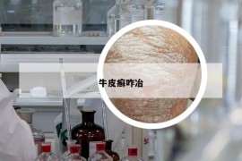 牛皮癬咋冶