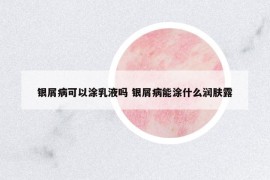 銀屑病可以涂乳液?jiǎn)?銀屑病能涂什么潤(rùn)膚露