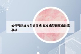 如何預(yù)防紅皮型銀屑病 紅皮病型銀屑病注意事項(xiàng)