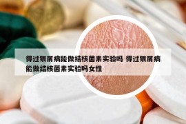 得過銀屑病能做結核菌素實驗嗎 得過銀屑病能做結核菌素實驗嗎女性