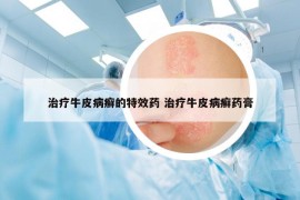 治療牛皮病癬的特效藥 治療牛皮病癬藥膏