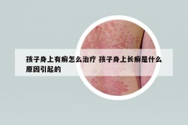 孩子身上有癬怎么治療 孩子身上長癬是什么原因引起的