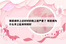 銀屑病早上還好好的晚上就嚴(yán)重了 銀屑病為什么早上起來(lái)特別好