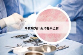 牛皮癬為什么只有頭上有