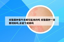 皮脂囊腫是牛皮癬引起來的嗎 皮脂囊腫一定要切除嗎,會留下疤痕嗎