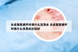 頭皮銀屑病平時用什么洗發(fā)水 頭皮銀屑病平時用什么洗發(fā)水比較好