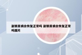 副銀屑病會(huì)恢復(fù)正常嗎 副銀屑病會(huì)恢復(fù)正常嗎圖片