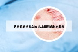 頭步銀翹病怎么治 頭上銀翹病越來(lái)越多