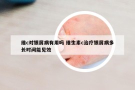 維c對(duì)銀屑病有用嗎 維生素c治療銀屑病多長(zhǎng)時(shí)間能見(jiàn)效