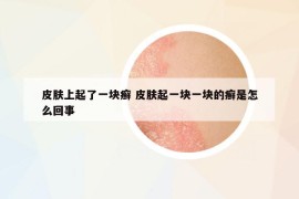 皮膚上起了一塊癬 皮膚起一塊一塊的癬是怎么回事