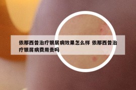 依那西普治療銀屑病效果怎么樣 依那西普治療銀屑病費(fèi)用貴嗎