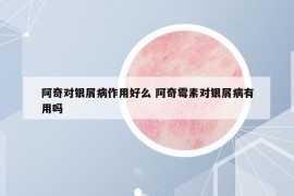 阿奇對銀屑病作用好么 阿奇霉素對銀屑病有用嗎