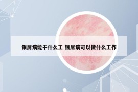 銀屑病能干什么工 銀屑病可以做什么工作