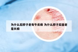 為什么后脖子老有牛皮癬 為什么脖子后面老是長(zhǎng)癬