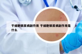 干細(xì)胞銀屑病副作用 干細(xì)胞銀屑病副作用是什么