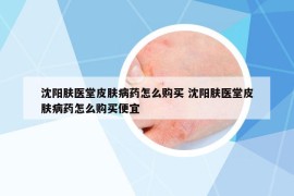 沈陽膚醫(yī)堂皮膚病藥怎么購買 沈陽膚醫(yī)堂皮膚病藥怎么購買便宜