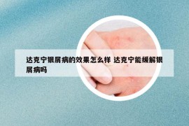 達(dá)克寧銀屑病的效果怎么樣 達(dá)克寧能緩解銀屑病嗎