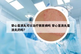 穿心蓮滴丸可以治療銀屑病嗎 穿心蓮滴丸是消炎藥嗎?