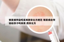 銀屑病傳染嗎采用西安北方規(guī)范 銀屑病會(huì)傳染給孩子嗎采用 西安北方