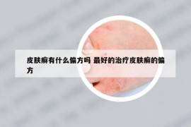 皮膚癬有什么偏方嗎 最好的治療皮膚癬的偏方
