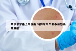 共享單車染上牛皮癬 騎共享單車會(huì)不會(huì)感染艾滋病