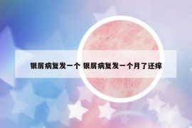 銀屑病復(fù)發(fā)一個(gè) 銀屑病復(fù)發(fā)一個(gè)月了還癢