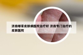濟(jì)南哪家皮膚病醫(yī)院治療好 濟(jì)南專(zhuān)門(mén)治療的皮膚醫(yī)院