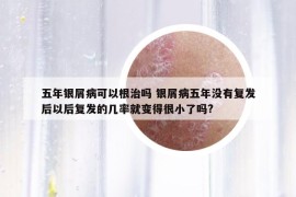 五年銀屑病可以根治嗎 銀屑病五年沒有復(fù)發(fā)后以后復(fù)發(fā)的幾率就變得很小了嗎?