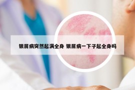 銀屑病突然起滿全身 銀屑病一下子起全身嗎